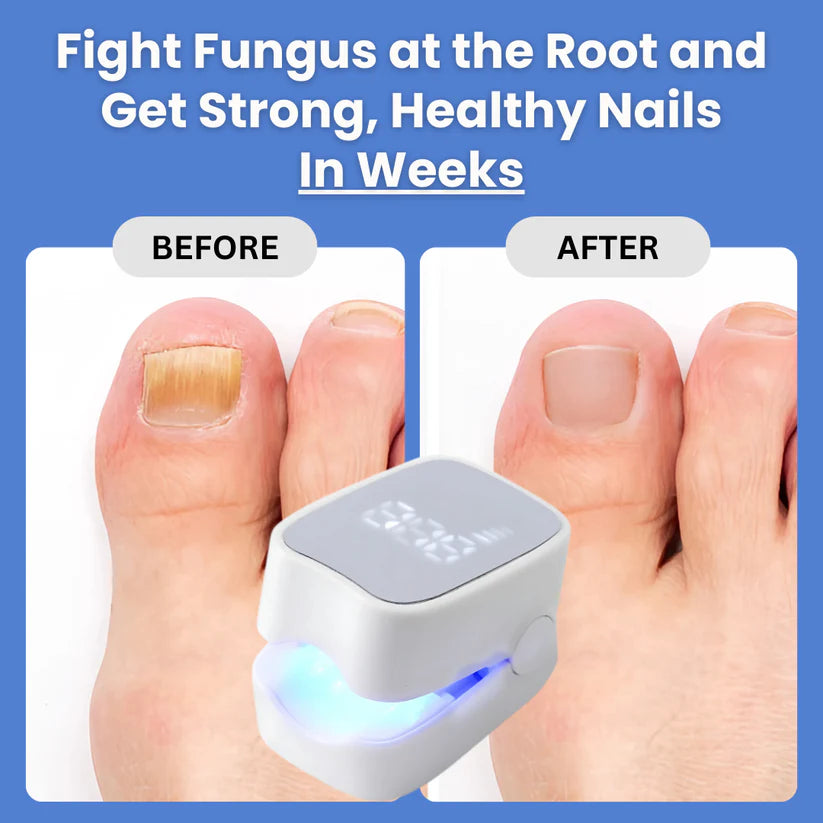 Nail Fungus Laser