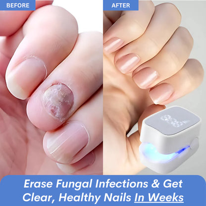 Nail Fungus Laser