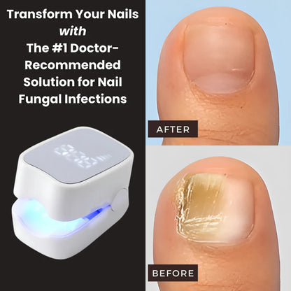Nail Fungus Laser